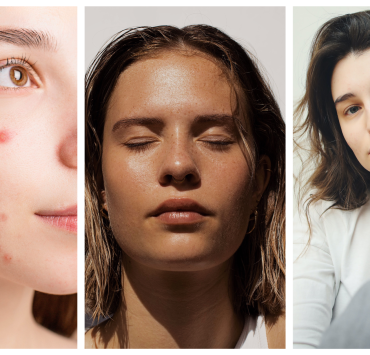6 Skin Problems That Aren’t Treatable With Any Skincare Products