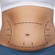 How Tummy Tuck Surgery Can Enhance Your Post-Pregnancy Body