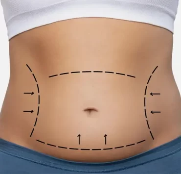 How Tummy Tuck Surgery Can Enhance Your Post-Pregnancy Body