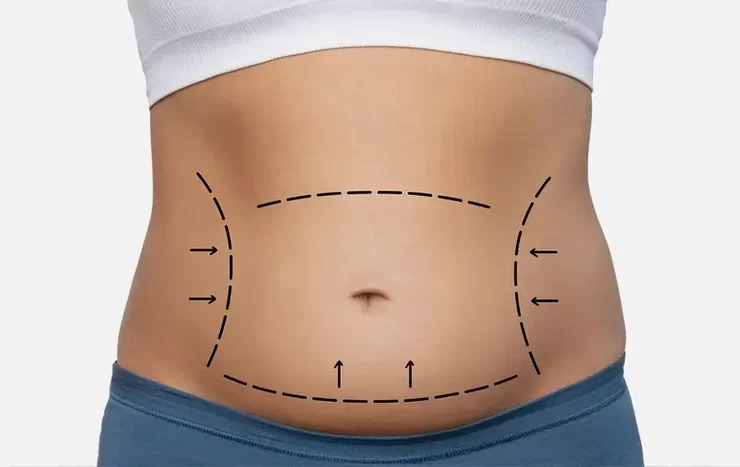How Tummy Tuck Surgery Can Enhance Your Post-Pregnancy Body